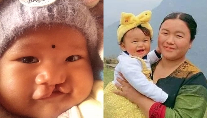 Cleft lip and Palate projects